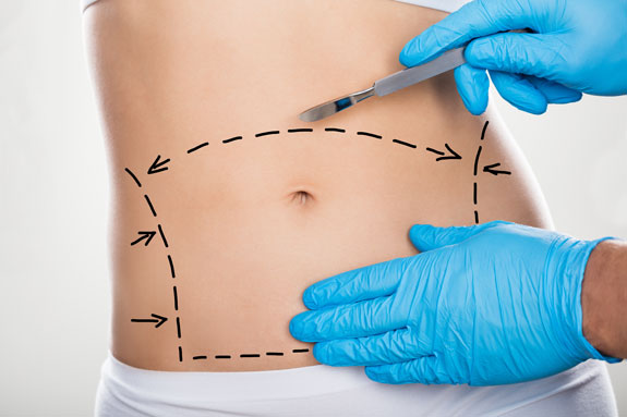 Abdominoplastik Erfurt